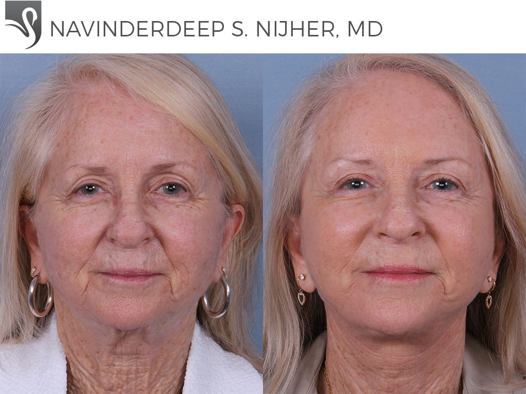 Before and After Image: Face Lift Case #5312 - front