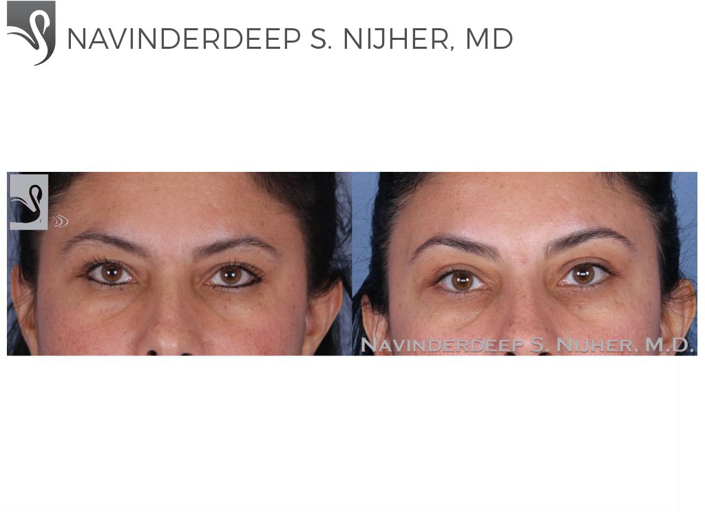 Before and After Image: Eyelid Surgery Case #53270 - front