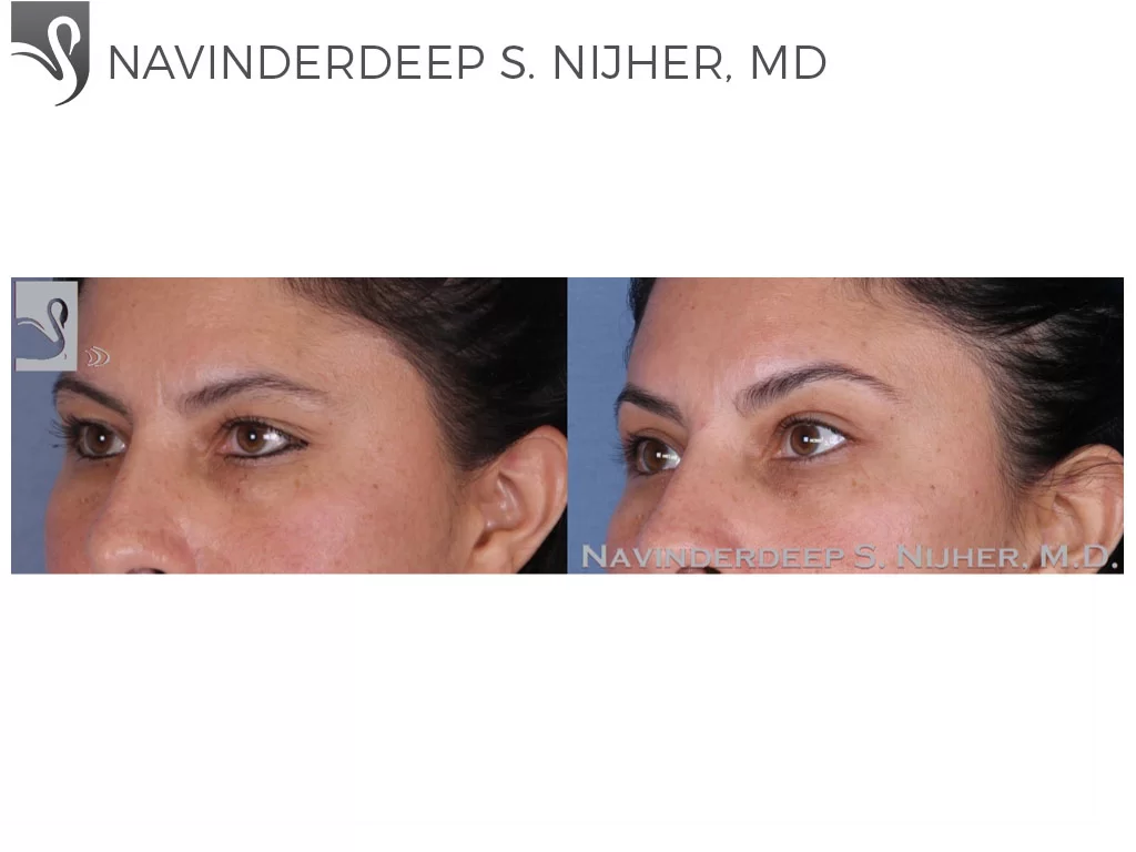 Before and After Image: Eyelid Surgery Case #53270 - left-front-oblique