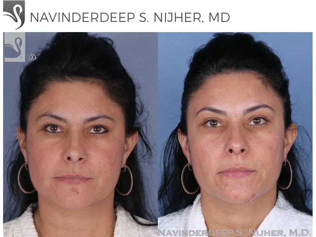 Before and After Image: Brow Lift Case #53270 - front