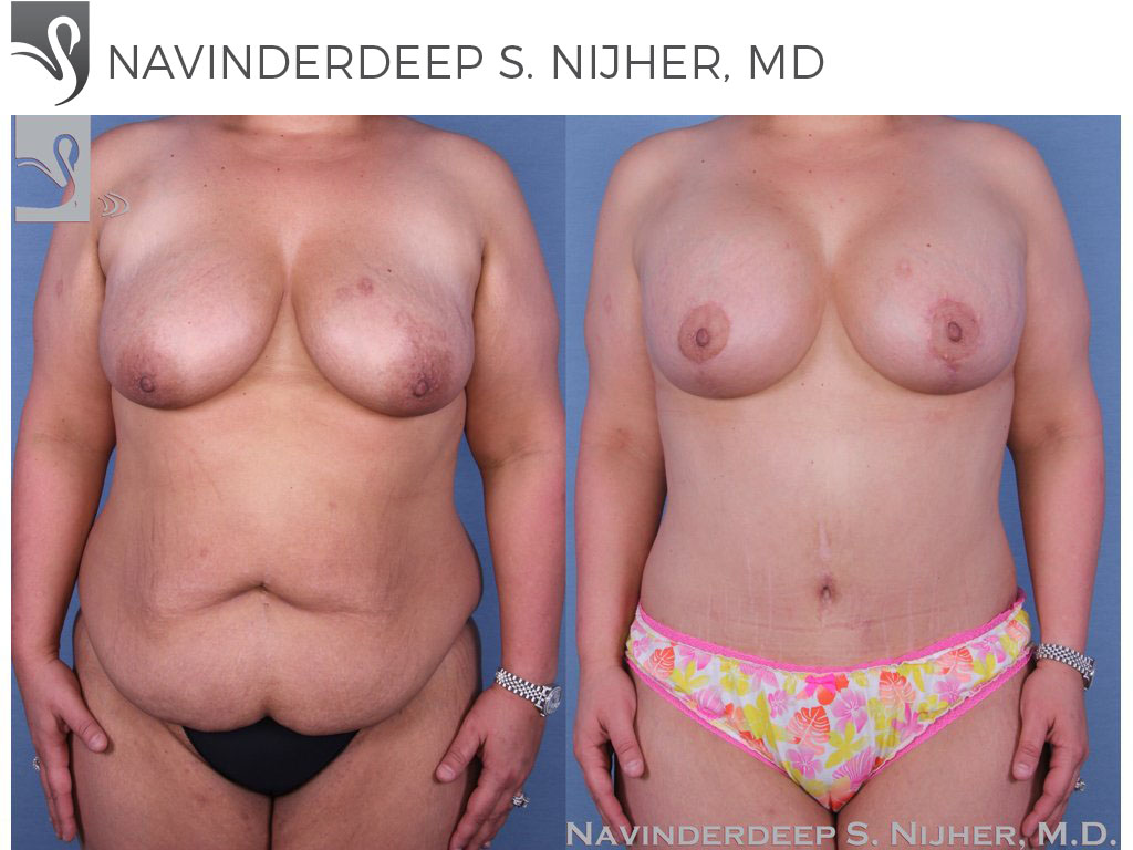 Before and After Image: Mommy Makeover Case #53626 - front