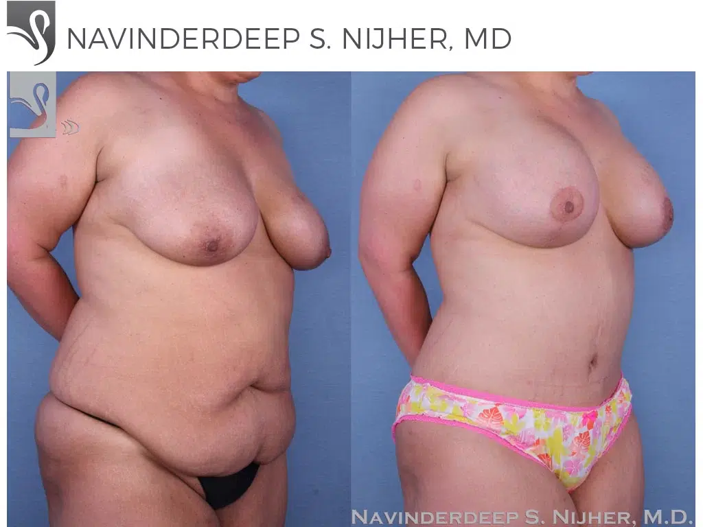 Before and After Image: Mommy Makeover Case #53626 - right-front-oblique