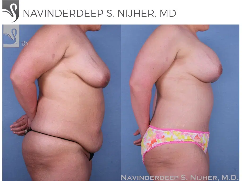 Before and After Image: Mommy Makeover Case #53626 - right-side