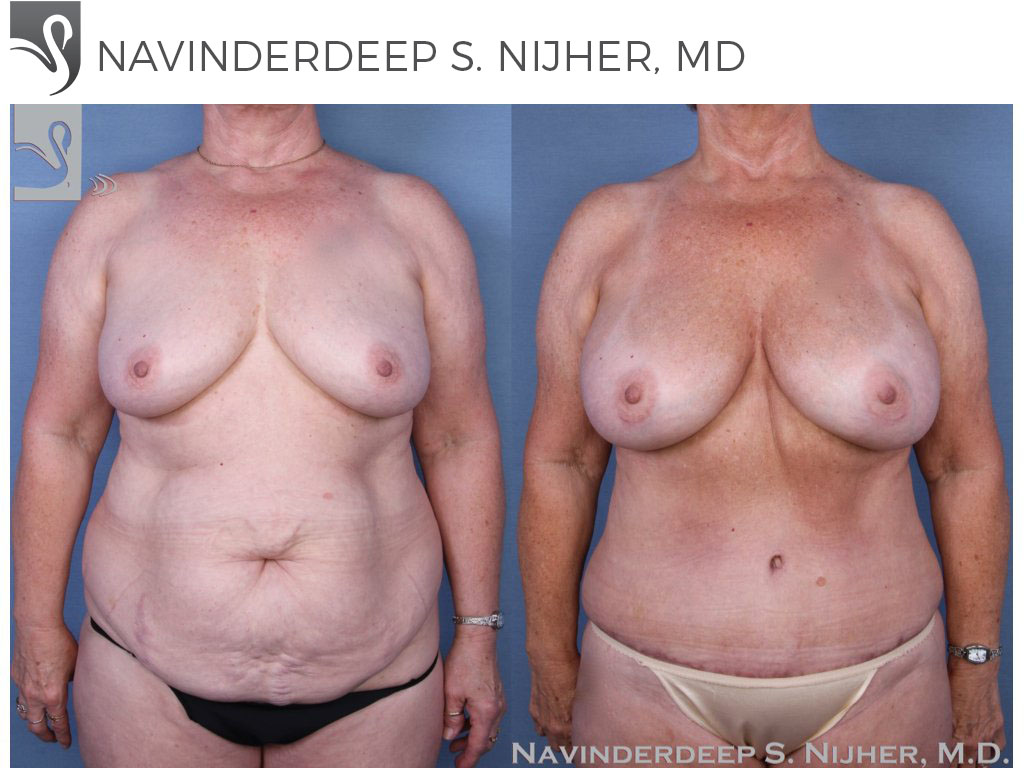 Before and After Image: Mommy Makeover Case #53717 - front