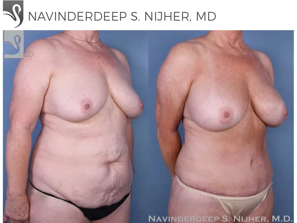 Before and After Image: Mommy Makeover Case #53717 - right-front-oblique