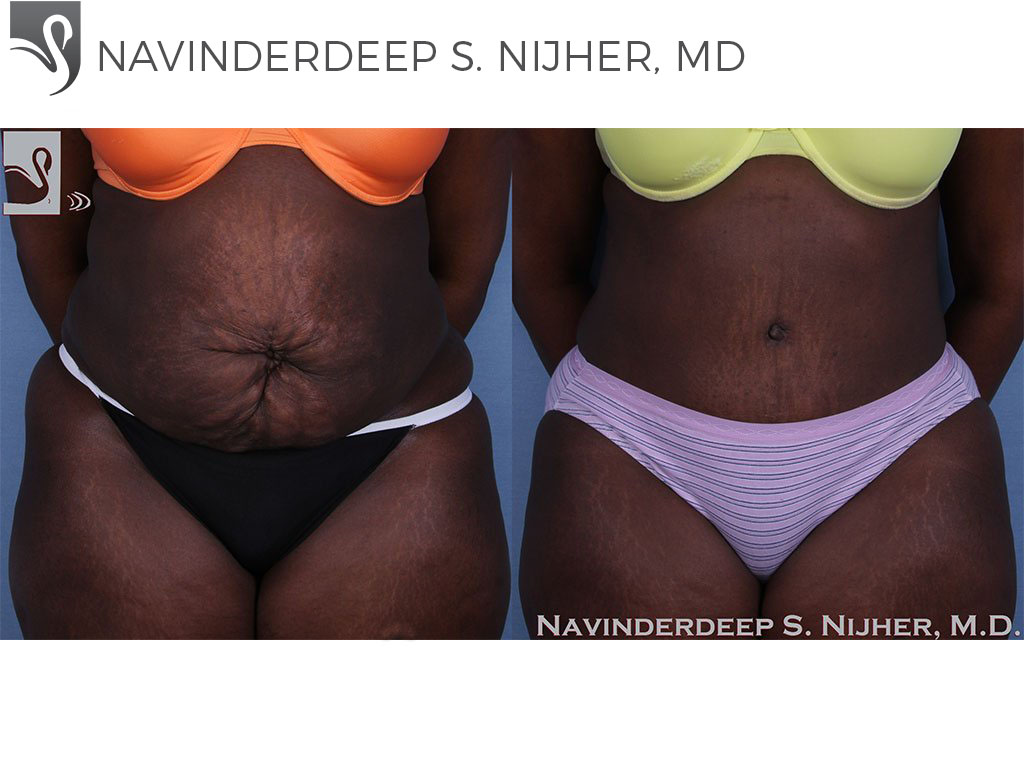 Before and After Image: Abdominoplasty (Tummy Tuck) Case #53719 - front