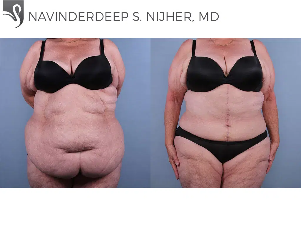 Before and After Image: Abdominoplasty (Tummy Tuck) Case #53953