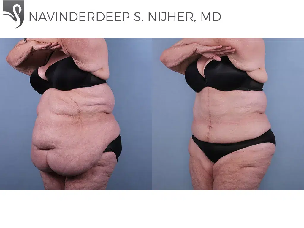 Before and After Image: Abdominoplasty (Tummy Tuck) Case #53953 - left-front-oblique