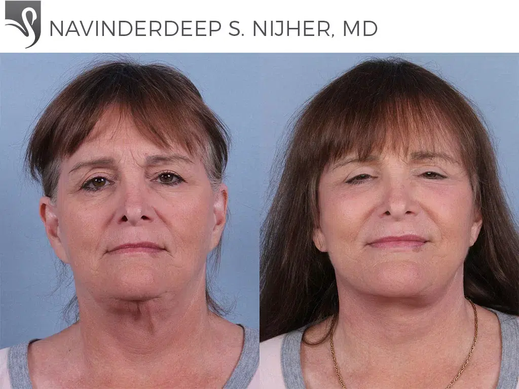 Before and After Image: Face Lift Case #53953