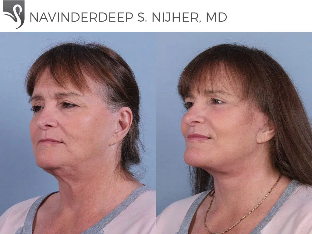 Before and After Image: Face Lift Case #53953 - left-front-oblique