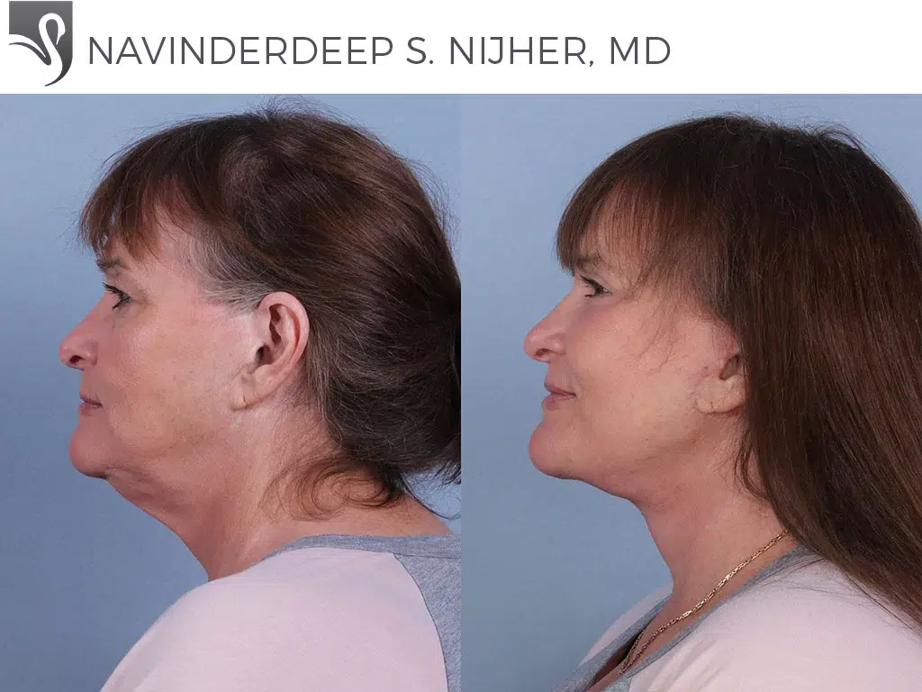 Before and After Image: Face Lift Case #53953 - left-side