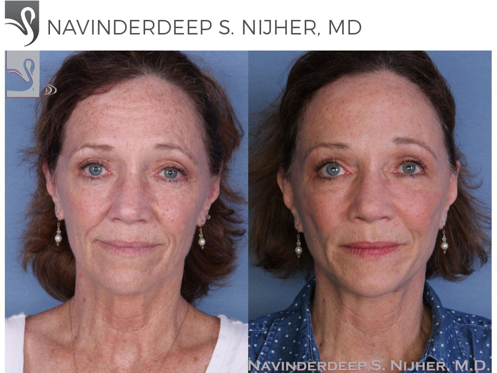 Before and After Image: Face Lift Case #24060 - front