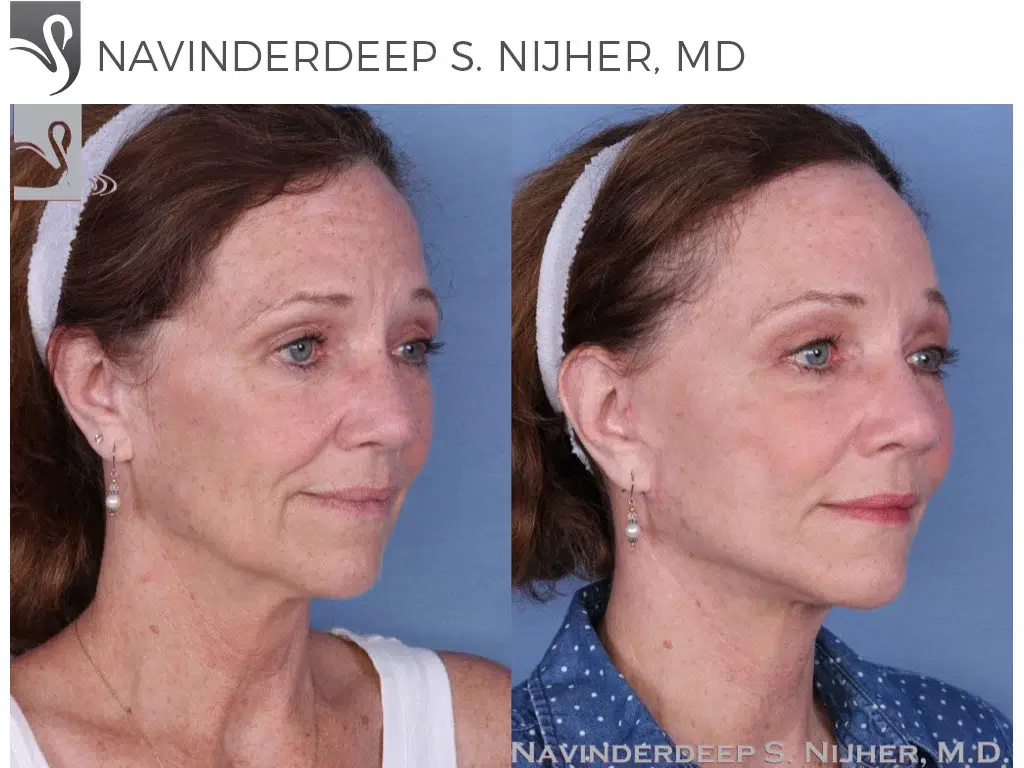 Before and After Image: Face Lift Case #24060 - right-front-oblique