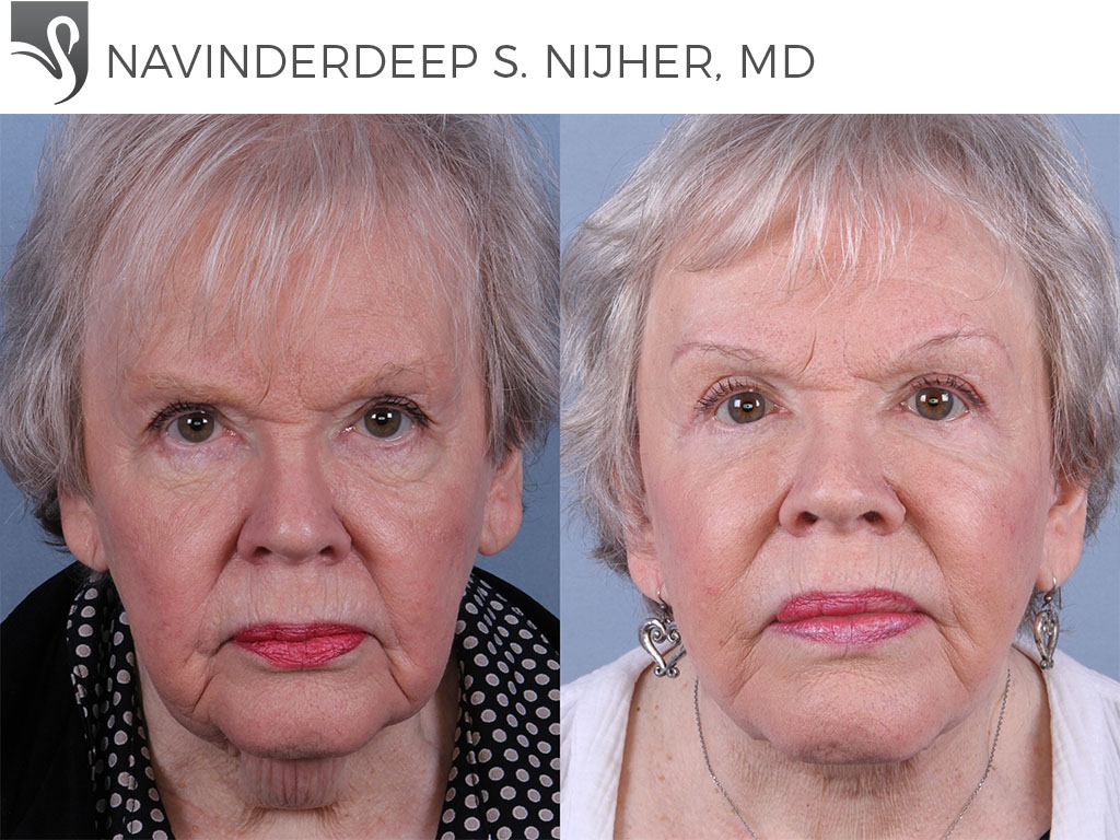 Before and After Image: Face Lift Case #54444 - front