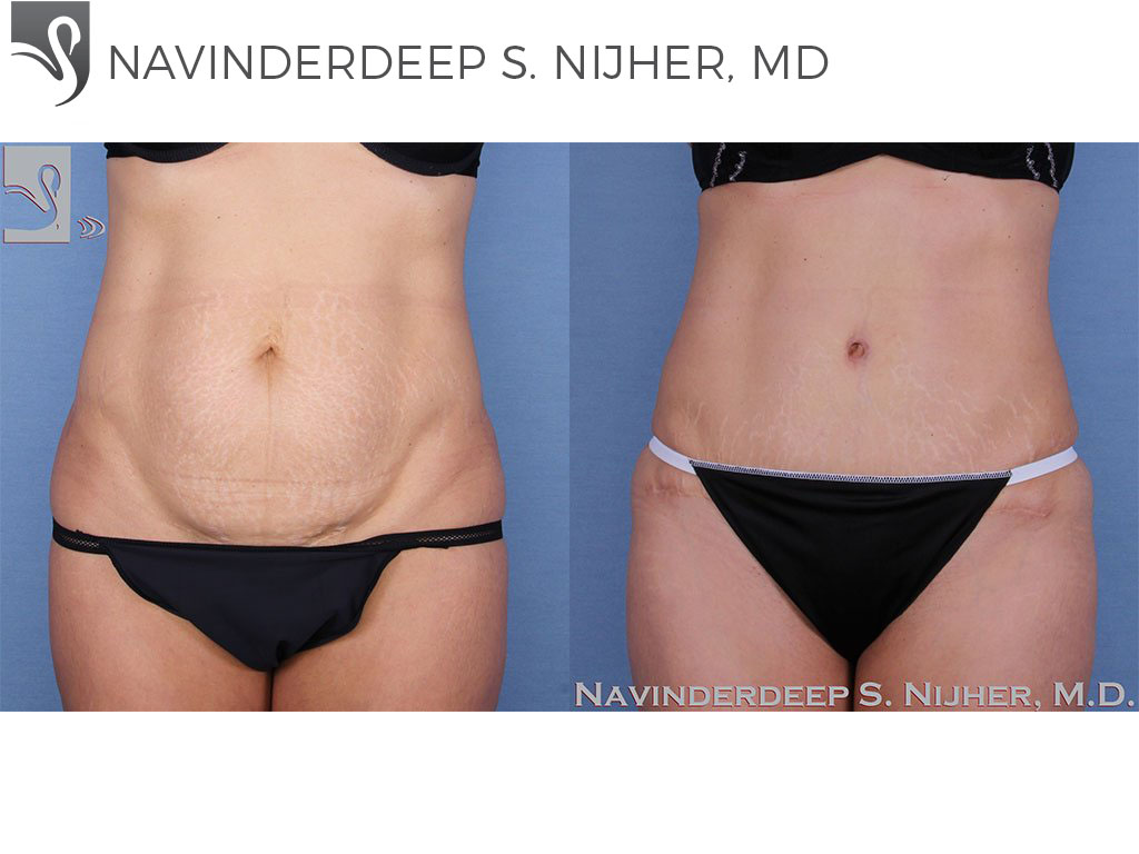 Before and After Image: Abdominoplasty (Tummy Tuck) Case #54649 - front
