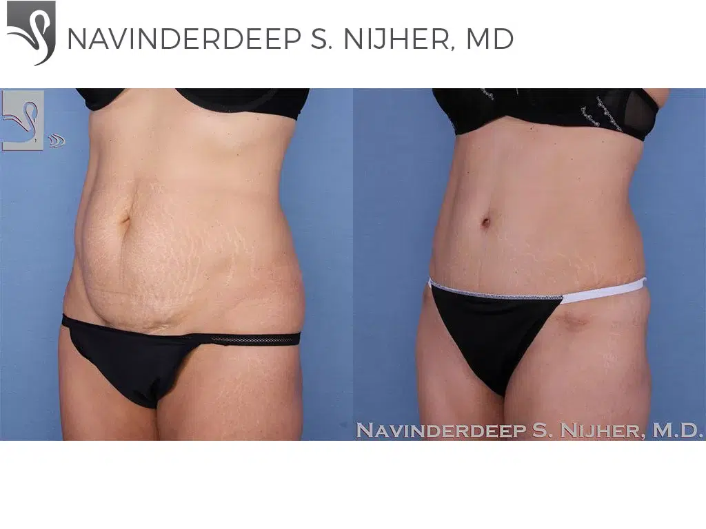 Before and After Image: Abdominoplasty (Tummy Tuck) Case #54649 - left-front-oblique