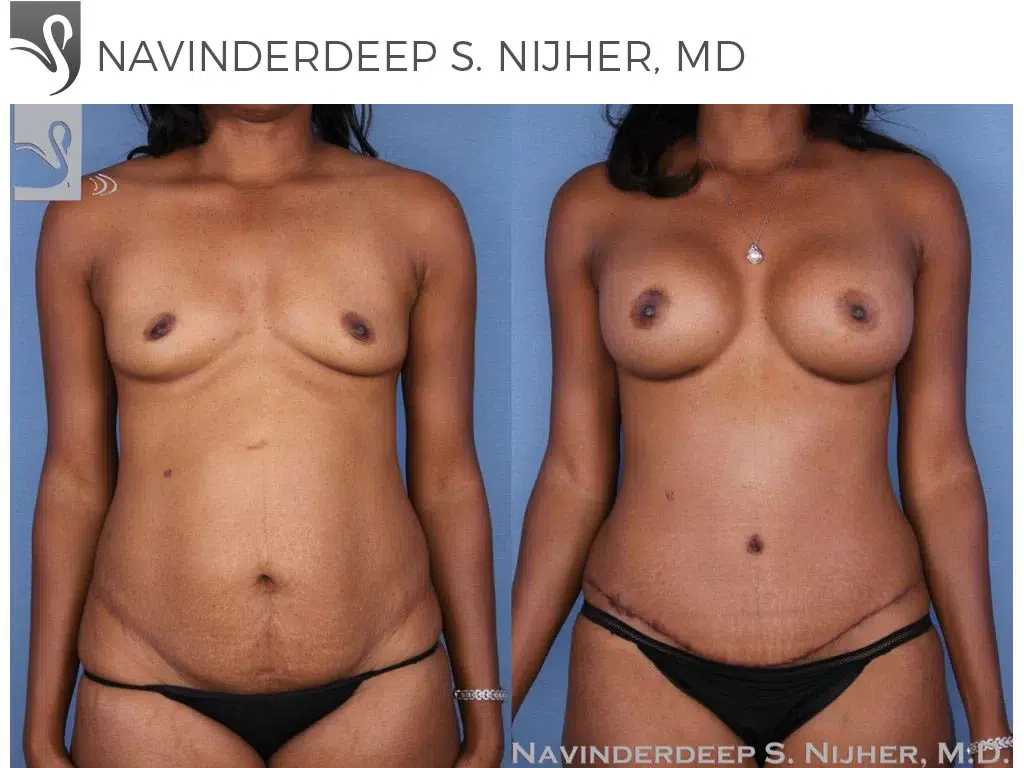 Before and After Image: Mommy Makeover Case #54755 - front