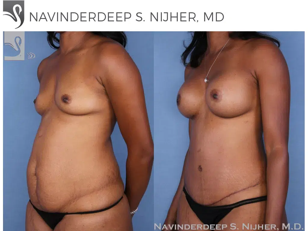 Before and After Image: Mommy Makeover Case #54755 - left-front-oblique