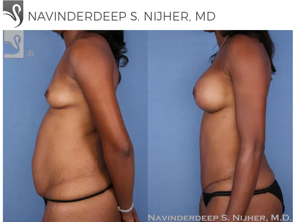 Before and After Image: Mommy Makeover Case #54755 - left-side
