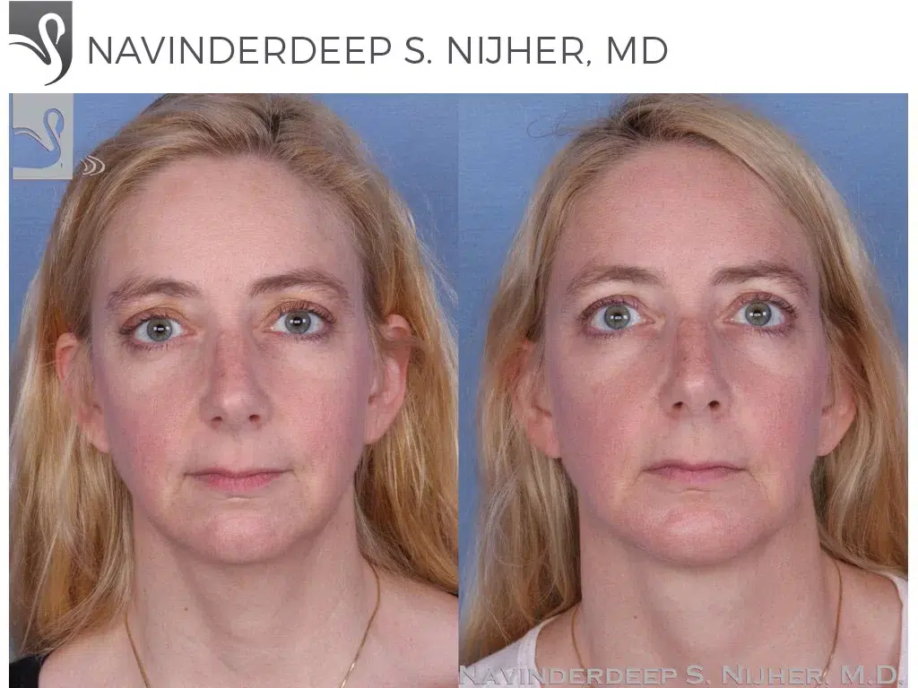 Before and After Image: Facial Implants Case #54883