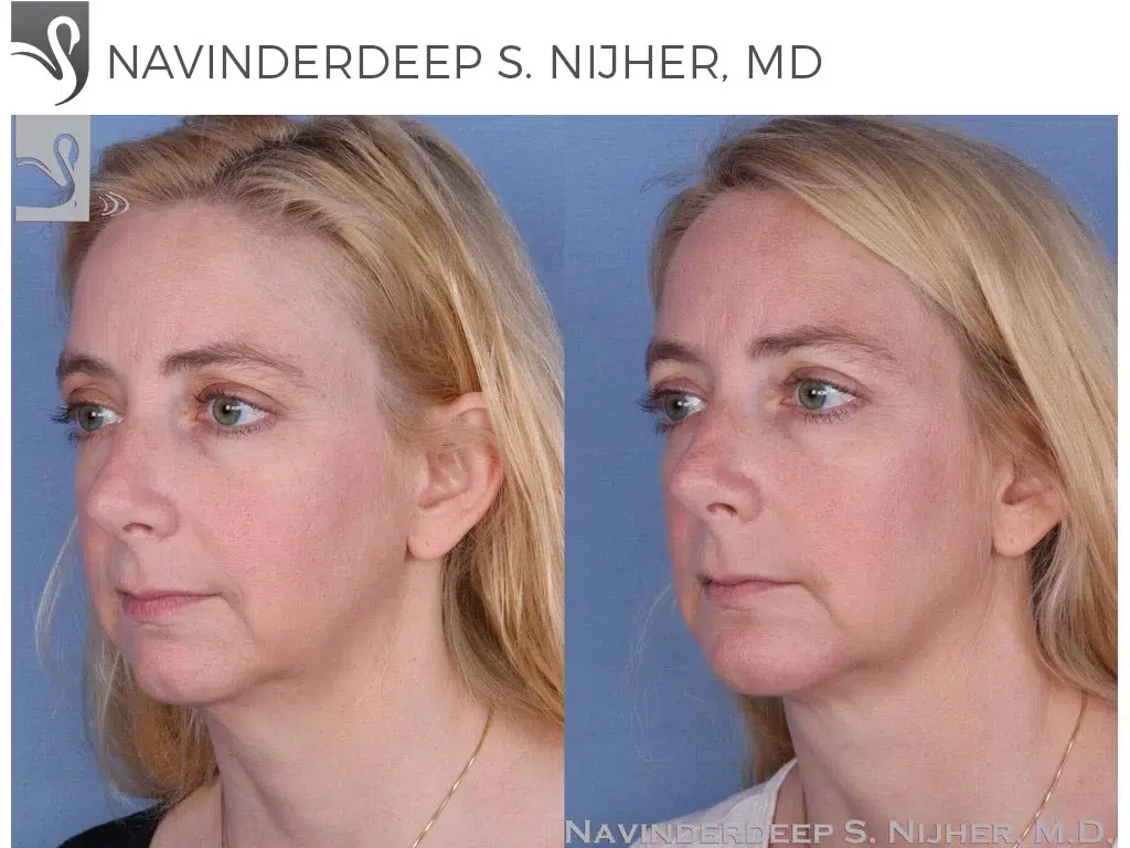Before and After Image: Facial Implants Case #54883 - left-front-oblique