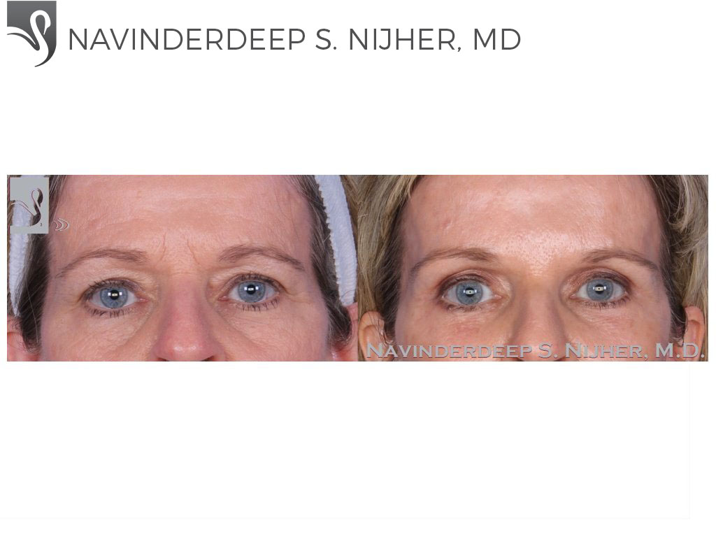 Before and After Image: Eyelid Surgery Case #55011 - front