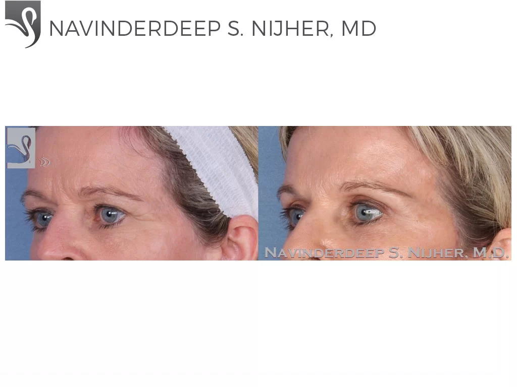 Before and After Image: Eyelid Surgery Case #55011 - left-front-oblique