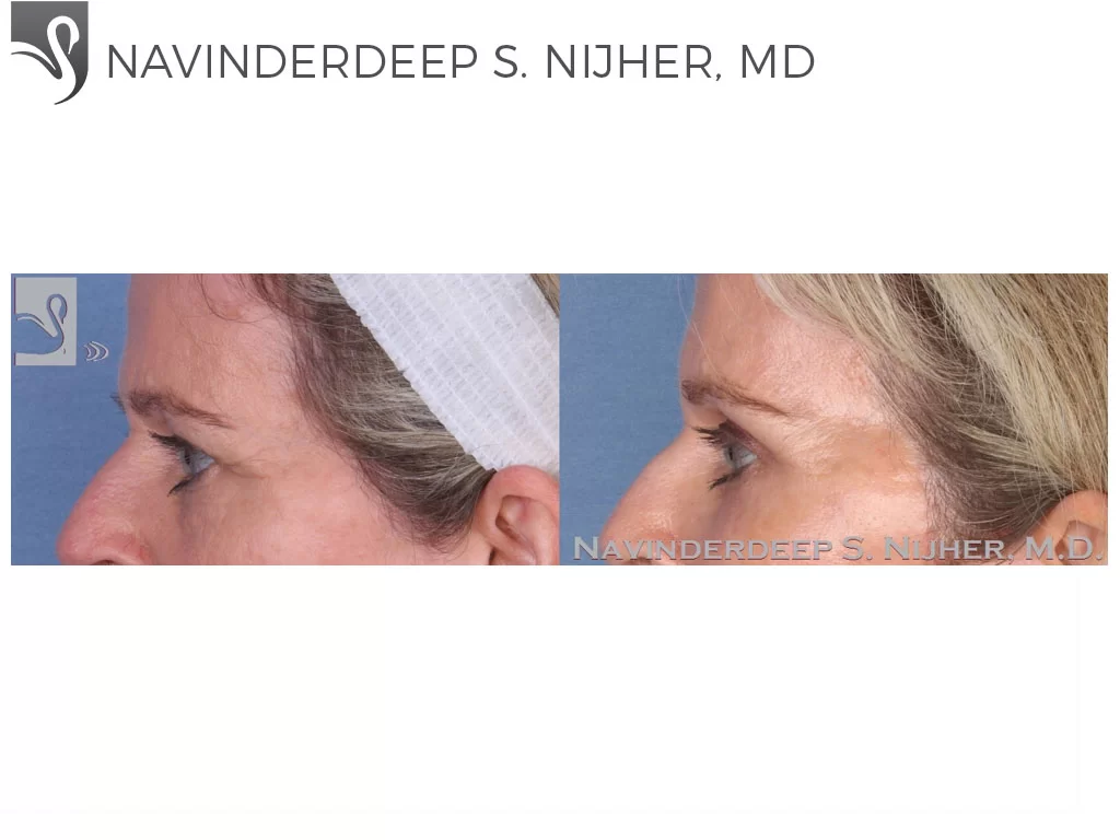 Before and After Image: Eyelid Surgery Case #55011 - left-side