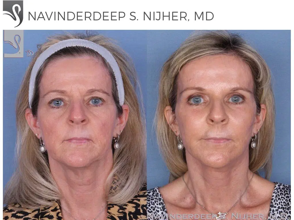 Before and After Image: Face Lift Case #55011 - front