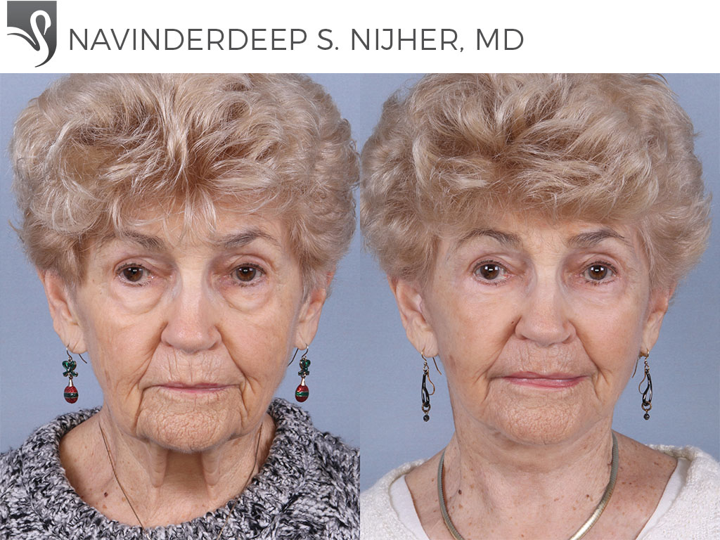 Before and After Image: Face Lift Case #55083 - front