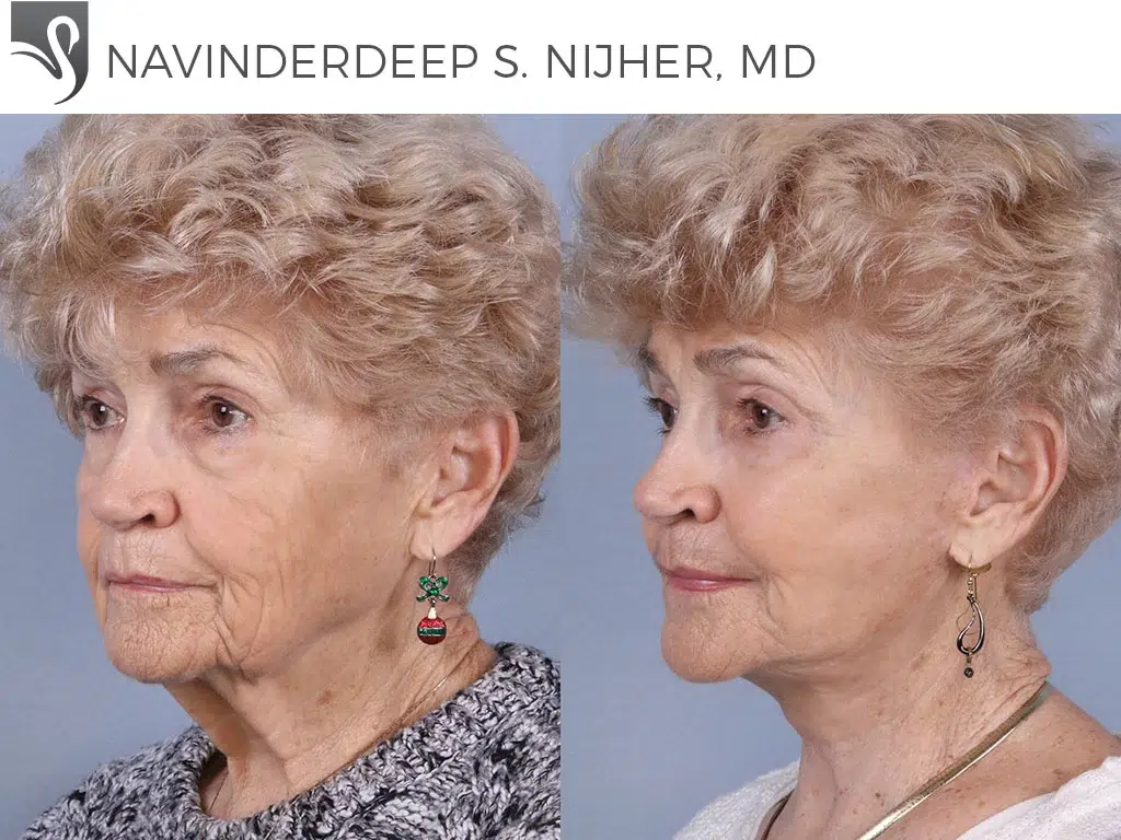 Before and After Image: Face Lift Case #55083 - left-front-oblique