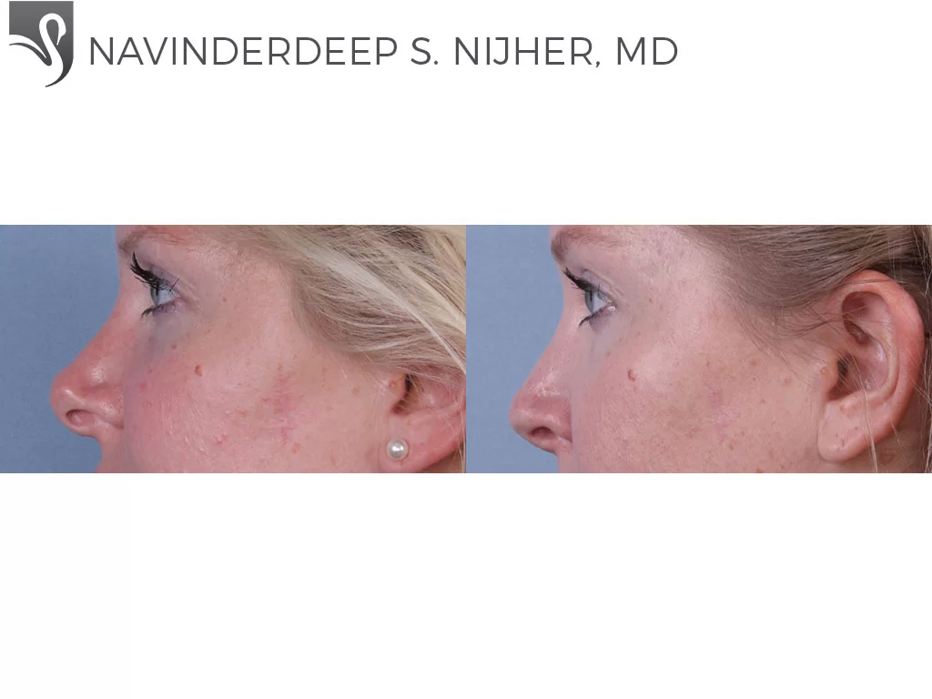 Before and After Image: Rhinoplasty Case #55388 - left-side