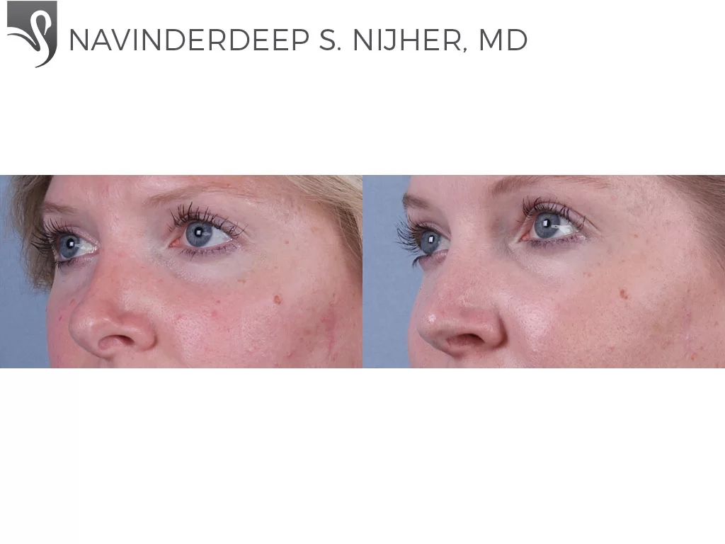 Before and After Image: Rhinoplasty Case #55388 - left-front-oblique