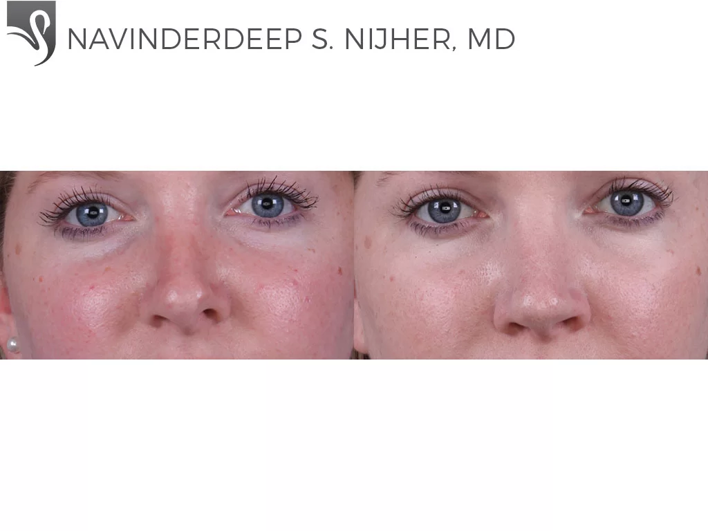 Before and After Image: Rhinoplasty Case #55388 - front