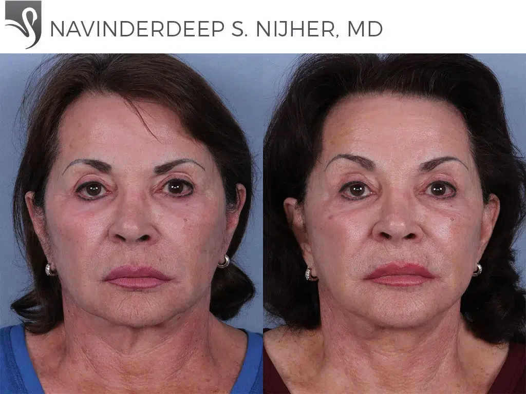 Before and After Image: Face Lift Case #55428 - front