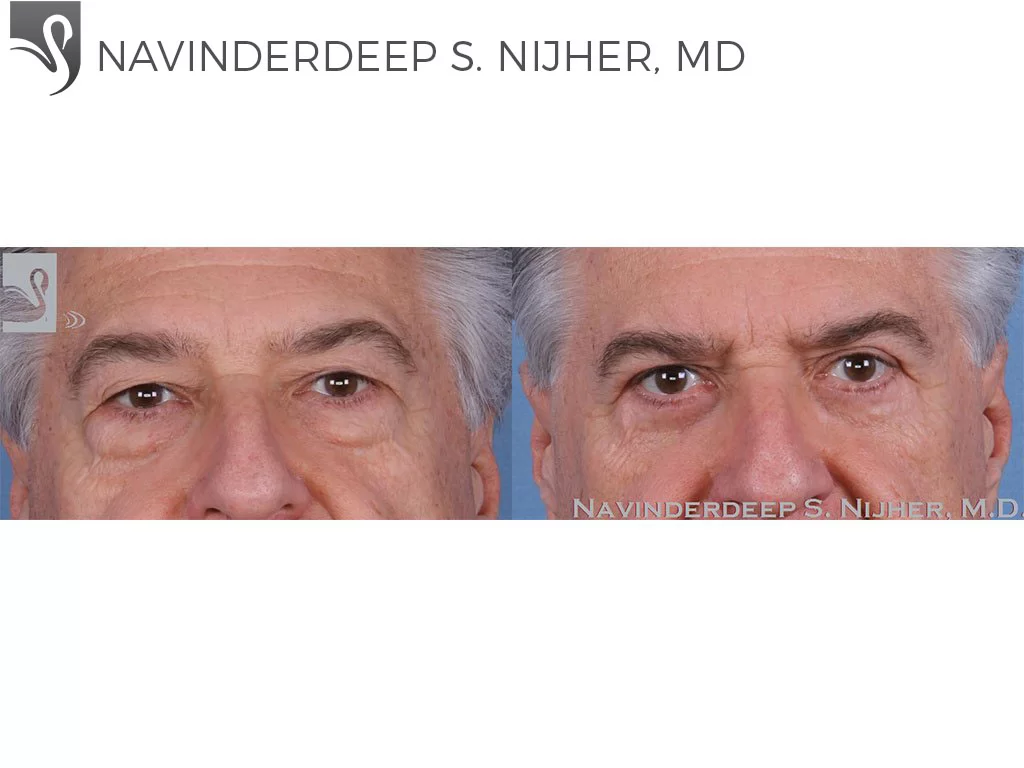 Before and After Image: Eyelid Surgery Case #56880 - front