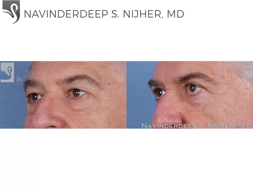 Before and After Image: Eyelid Surgery Case #56880 - left-front-oblique