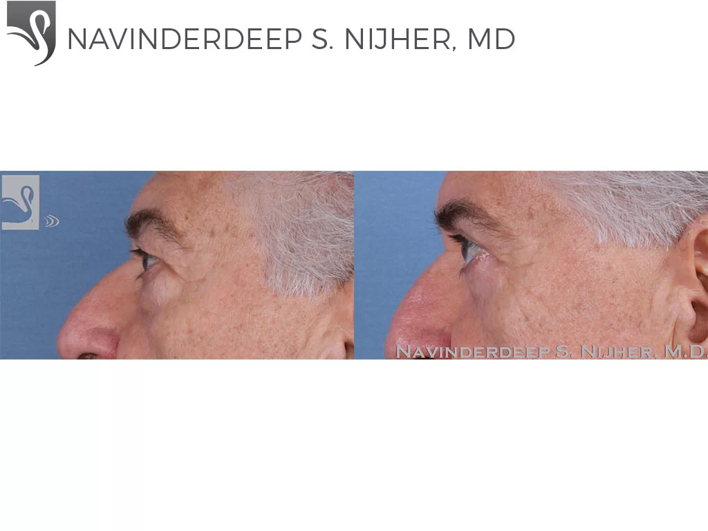 Before and After Image: Eyelid Surgery Case #56880 - left-side