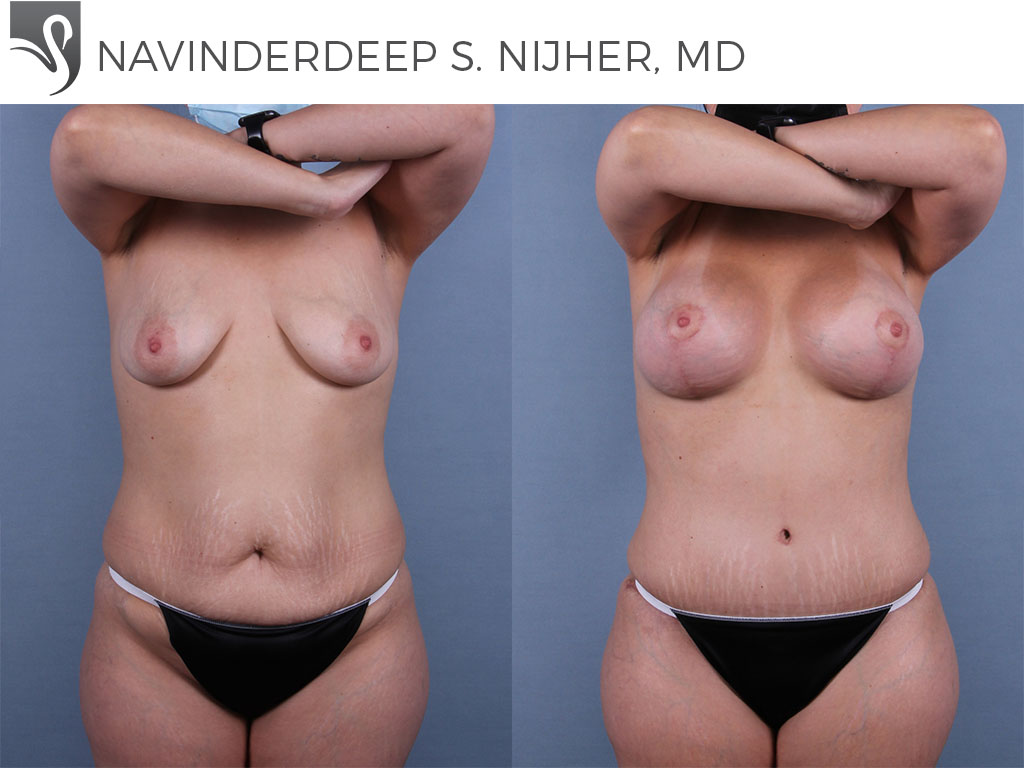 Before and After Image: Mommy Makeover Case #57000 - front