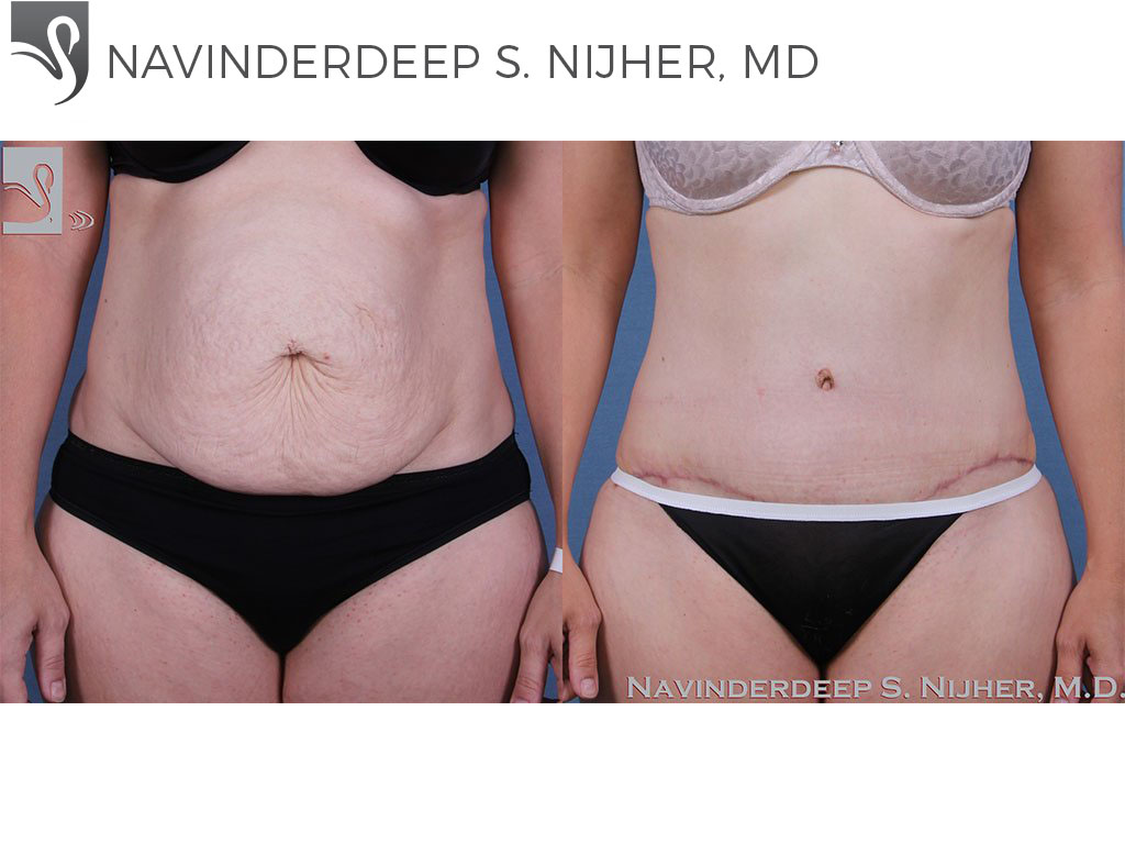 Before and After Image: Abdominoplasty (Tummy Tuck) Case #57169 - front