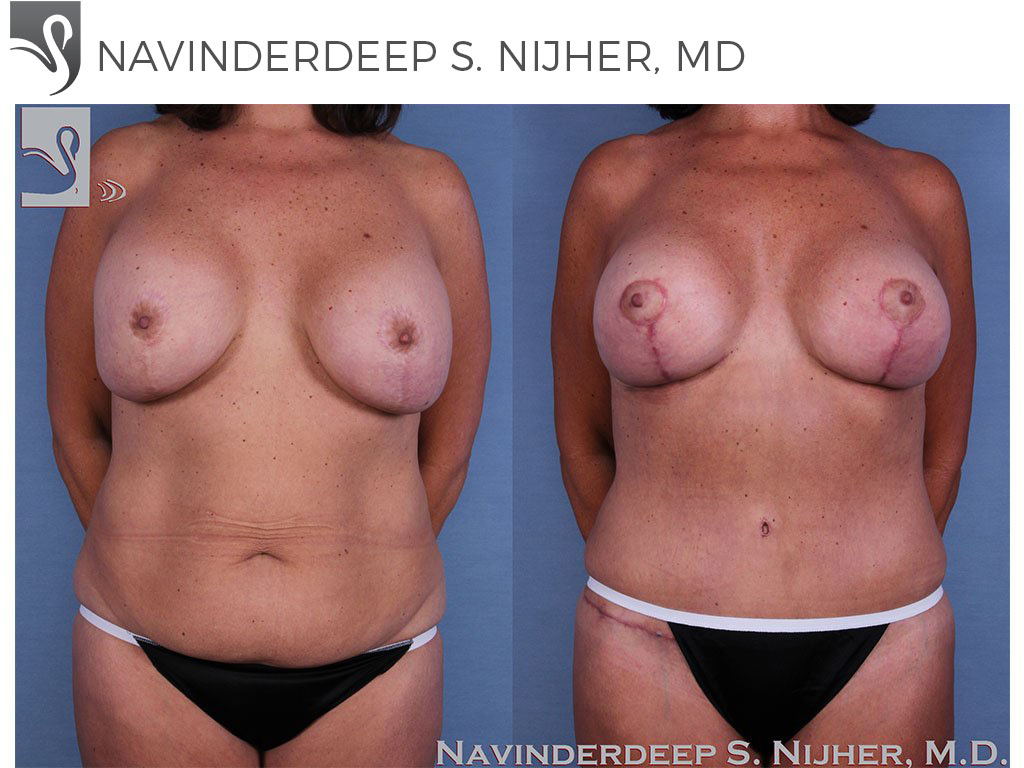 Before and After Image: Mommy Makeover Case #57351 - front