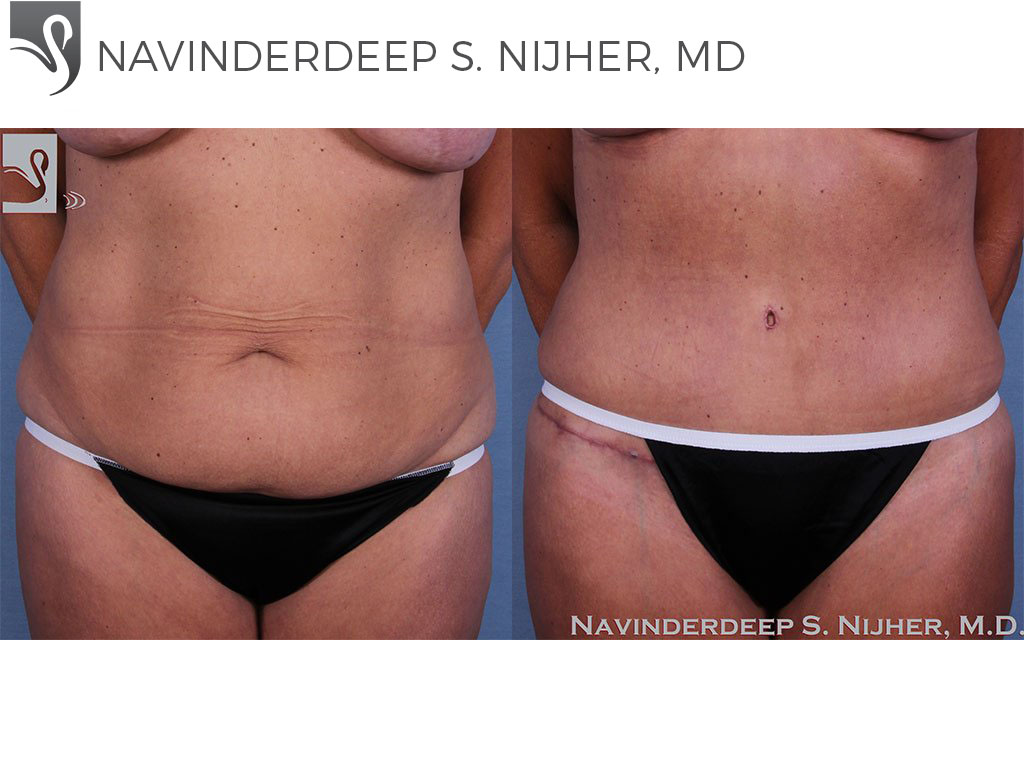 Before and After Image: Abdominoplasty (Tummy Tuck) Case #57351 - front