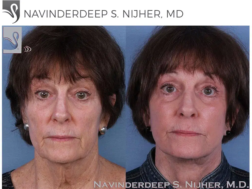 Before and After Image: Face Lift Case #57445 - front