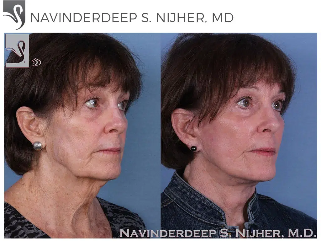 Before and After Image: Face Lift Case #57445 - right-front-oblique