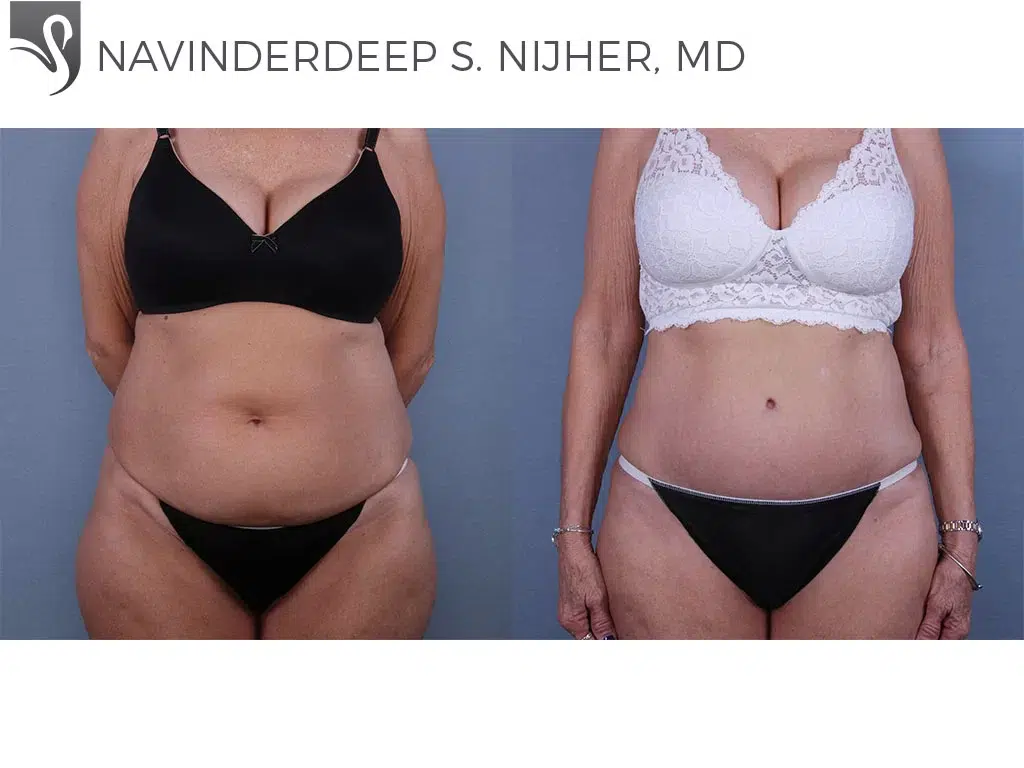 Before and After Image: Abdominoplasty (Tummy Tuck) Case #57481 - front