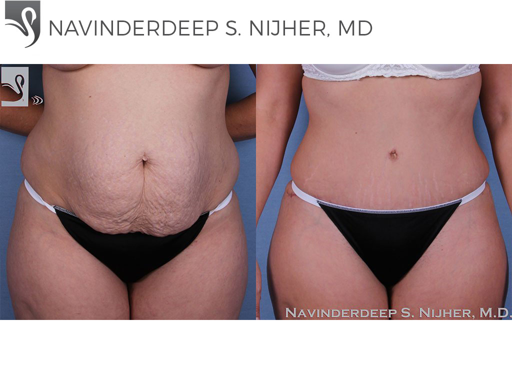 Before and After Image: Abdominoplasty (Tummy Tuck) Case #57815 - front