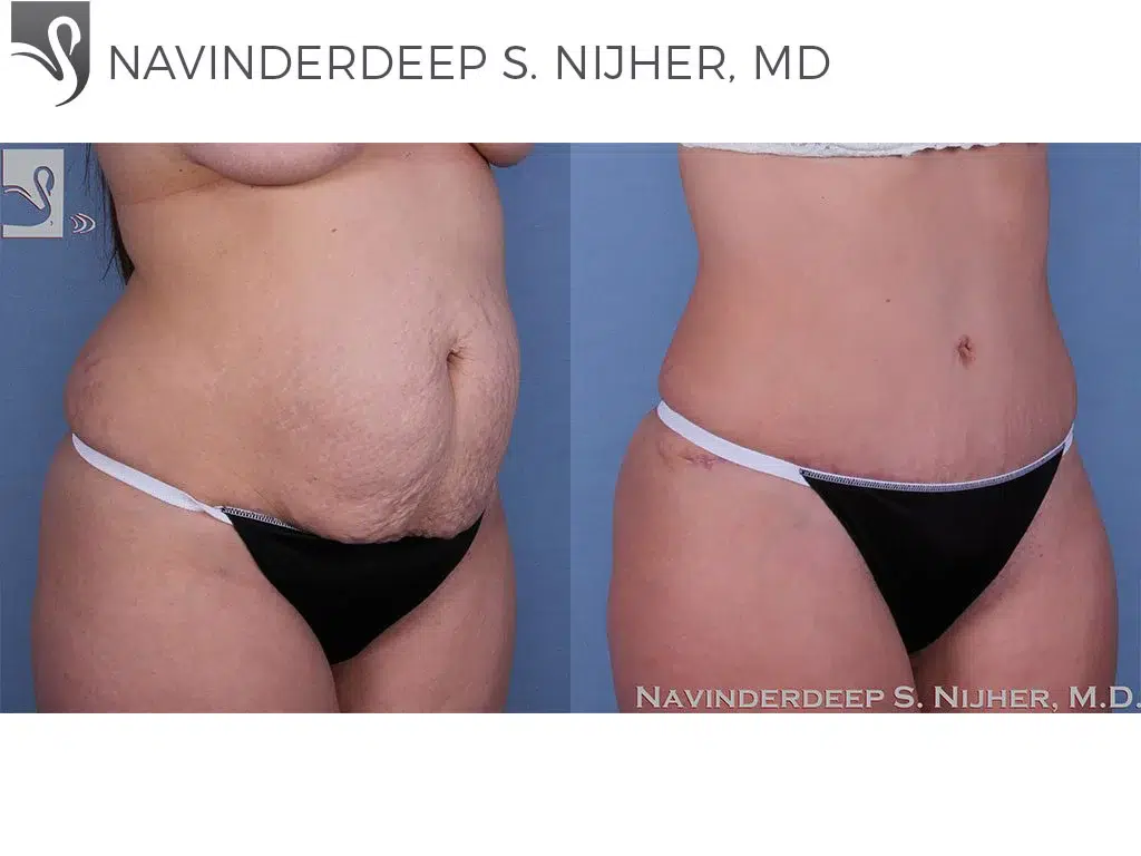 Before and After Image: Abdominoplasty (Tummy Tuck) Case #57815 - right-front-oblique