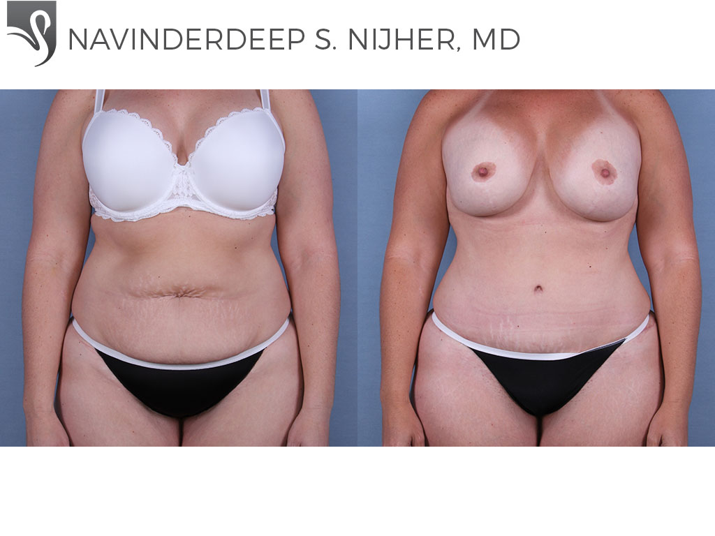Before and After Image: Abdominoplasty (Tummy Tuck) Case #57912 - front