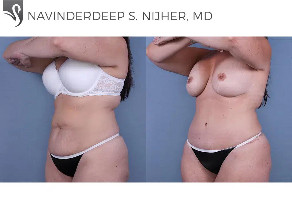 Before and After Image: Abdominoplasty (Tummy Tuck) Case #57912 - left-front-oblique