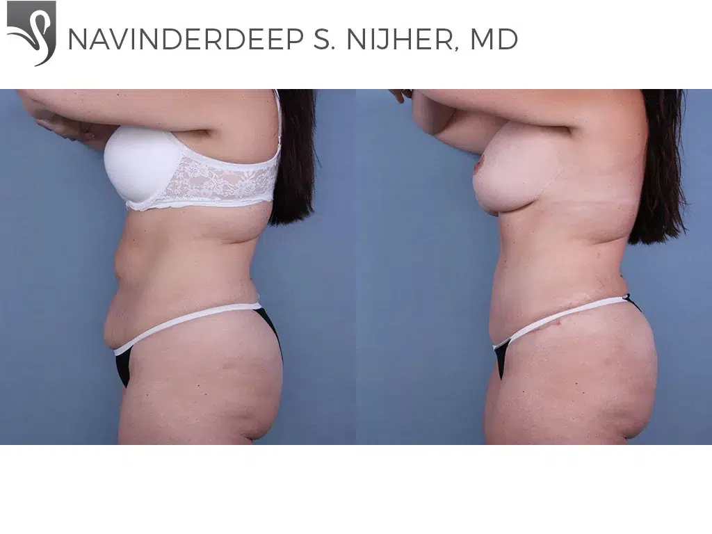 Before and After Image: Abdominoplasty (Tummy Tuck) Case #57912 - left-side